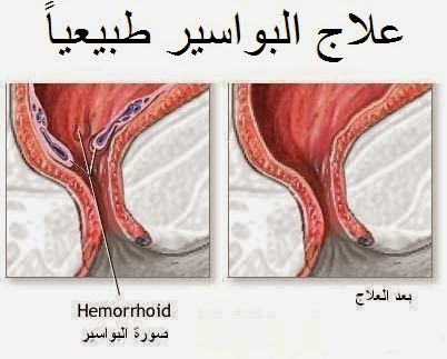 مرض البواسير - اعراض البواسير وطريقه العلاج 4787 2