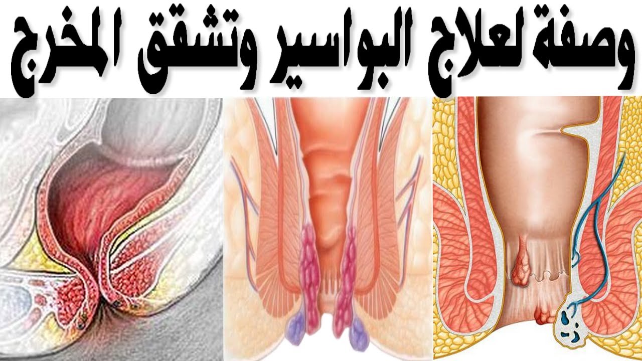 البواسير الخارجية وعلاجها 12973