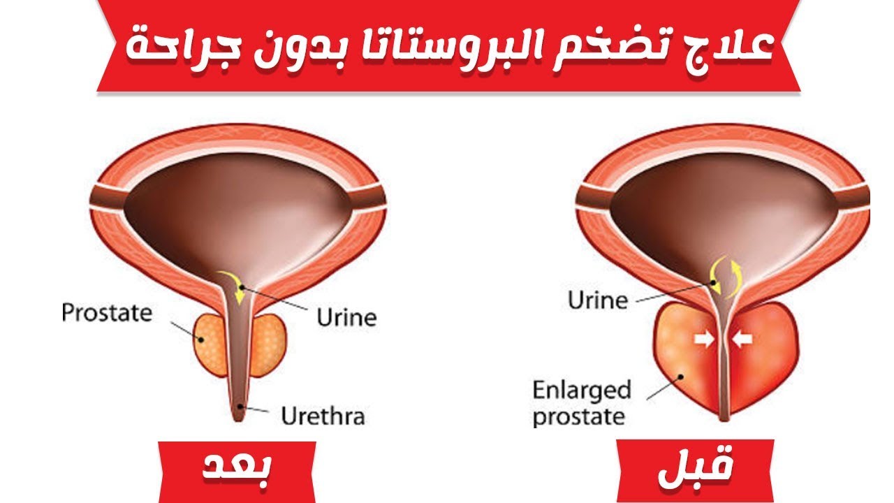 حاجة طبيعية - علاج تضخم البروستاتا 5750