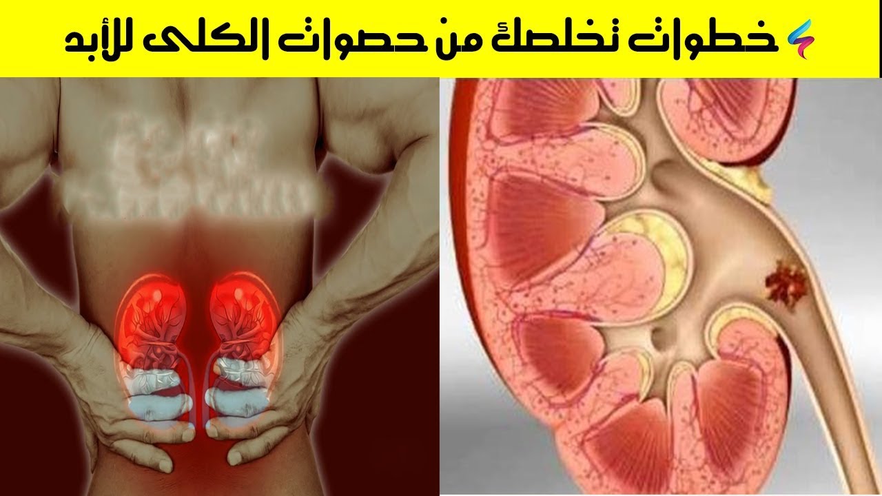 كيفية التخلص من الحصى في الكلى