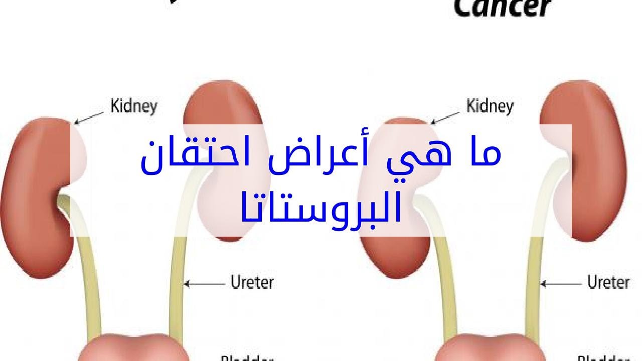 اعراض البروستاتا - كيف نكتشف اصابتنا بالبروستاتا