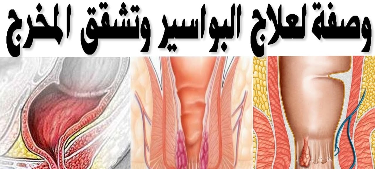 مرض البواسير - اعراض البواسير وطريقه العلاج 4787