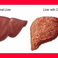 6244 2 علاج تليف الكبد - علاج فيرس الالتهاب الكبدي رحيق