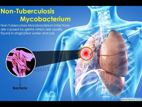 علاج مرض السل , افضل طريقة لعلاج مرض السل