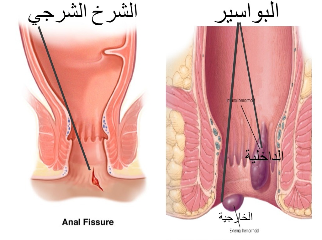 اعراض البواسير , كيف اكتشف اصابتى بالبواسير